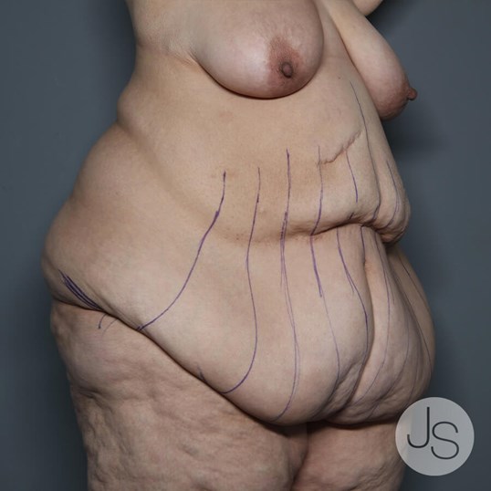 Tummy Tuck Before and After Pictures Beverly Hills, CA