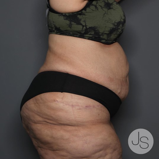 After Weight Loss Surgery Before and After Pictures Beverly Hills, CA