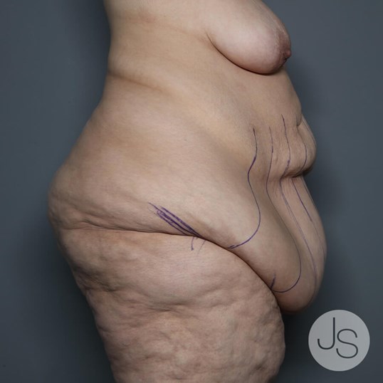 After Weight Loss Surgery Before and After Pictures Beverly Hills, CA