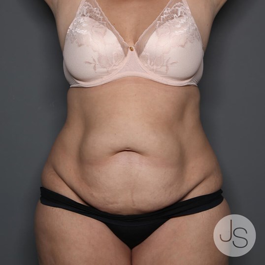 Tummy Tuck Before and After Pictures Beverly Hills, CA