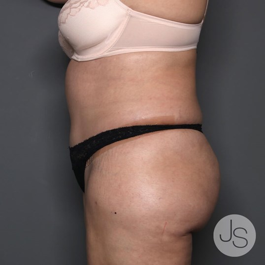 Tummy Tuck Before and After Pictures Beverly Hills, CA