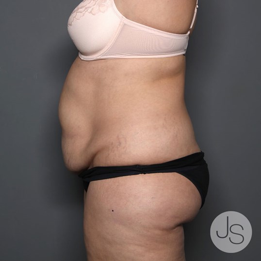 Tummy Tuck Before and After Pictures Beverly Hills, CA