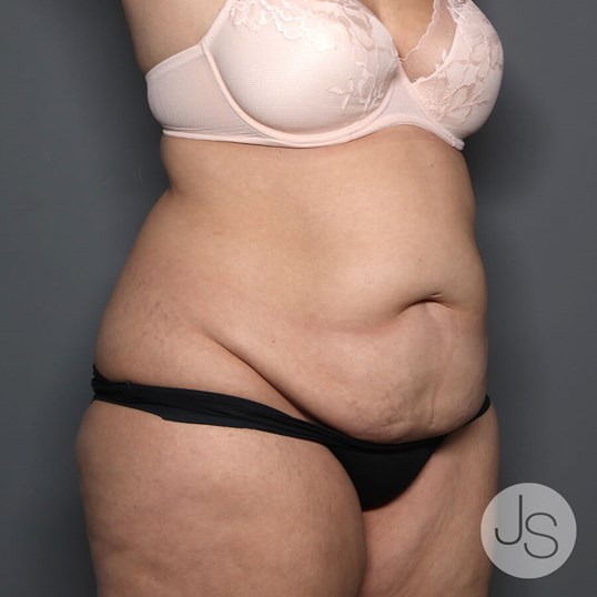 Tummy Tuck Before and After Pictures Beverly Hills, CA