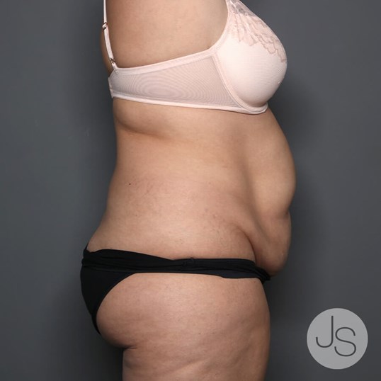 Tummy Tuck Before and After Pictures Beverly Hills, CA