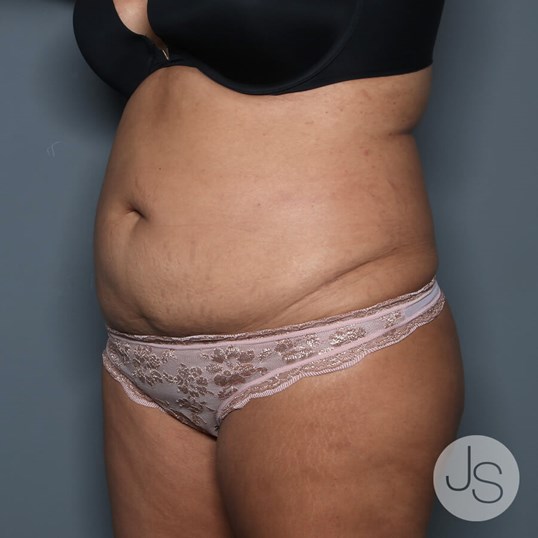 Tummy Tuck Before and After Pictures Beverly Hills, CA