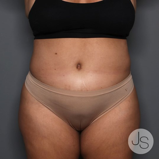 Tummy Tuck Before and After Pictures Beverly Hills, CA