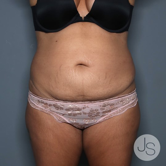 Tummy Tuck Before and After Pictures Beverly Hills, CA