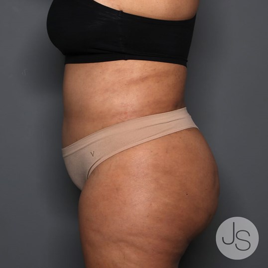 Tummy Tuck Before and After Pictures Beverly Hills, CA