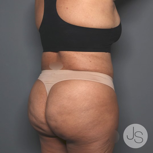 Tummy Tuck Before and After Pictures Beverly Hills, CA