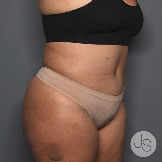 Tummy Tuck Before and After Pictures Beverly Hills, CA