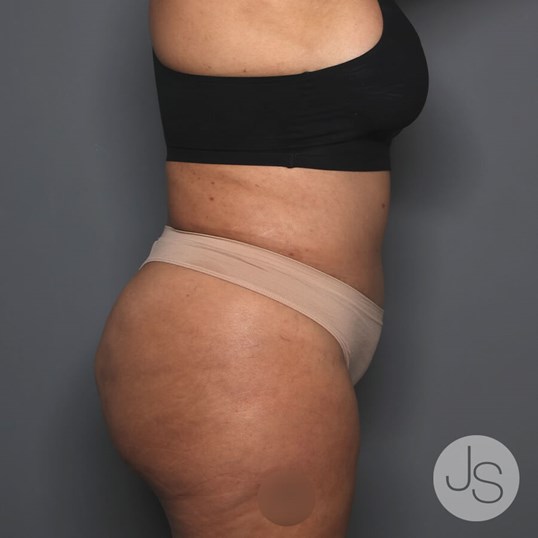 Tummy Tuck Before and After Pictures Beverly Hills, CA