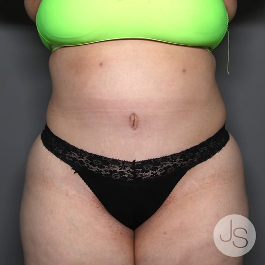 Tummy Tuck Before and After Pictures Beverly Hills, CA