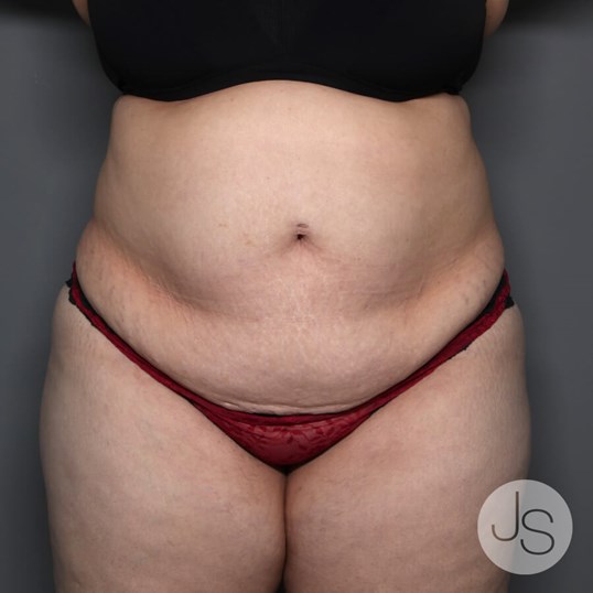 Tummy Tuck Before and After Pictures Beverly Hills, CA