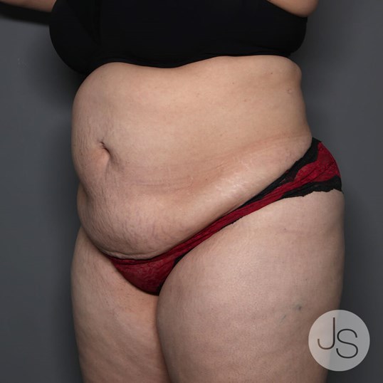 Tummy Tuck Before and After Pictures Beverly Hills, CA