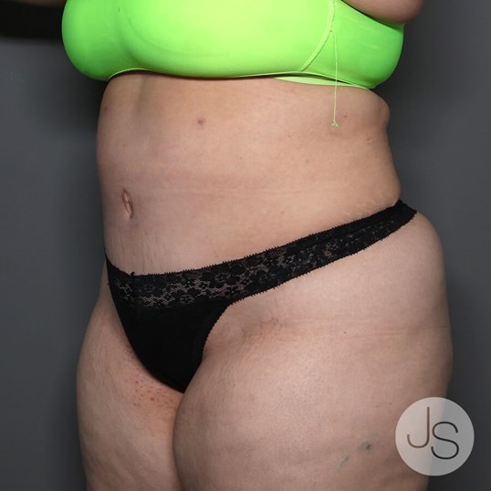 Tummy Tuck Before and After Pictures Beverly Hills, CA