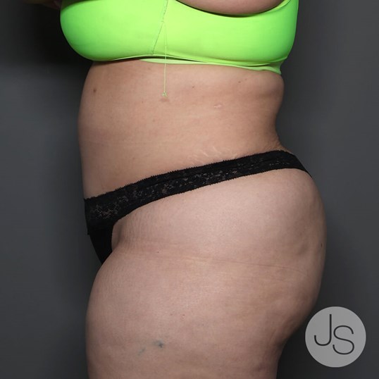 Tummy Tuck Before and After Pictures Beverly Hills, CA