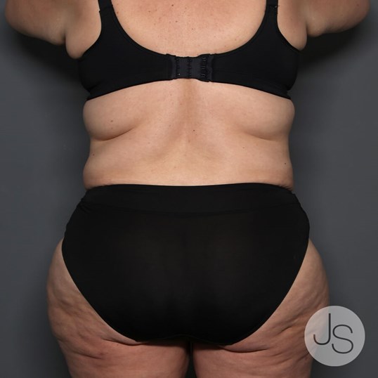 Tummy Tuck Before and After Pictures Beverly Hills, CA