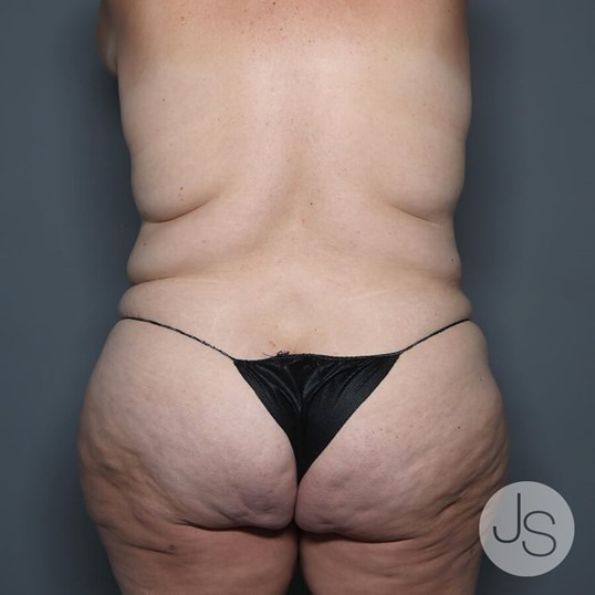 Tummy Tuck Before and After Pictures Beverly Hills, CA