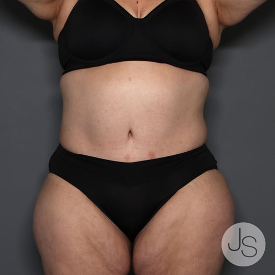 Tummy Tuck Before and After Pictures Beverly Hills, CA