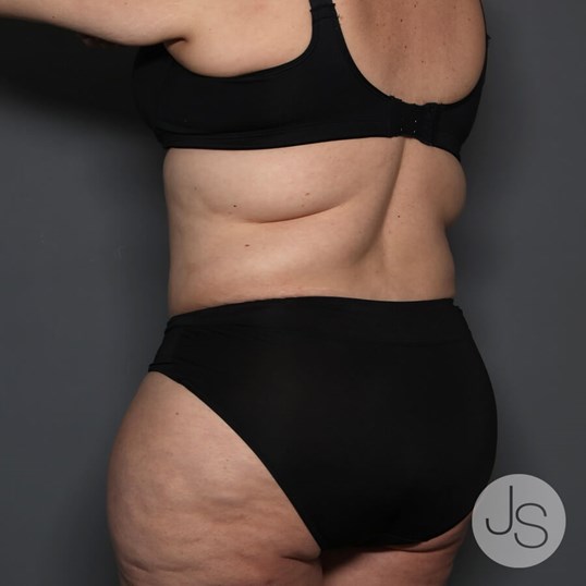 Tummy Tuck Before and After Pictures Beverly Hills, CA