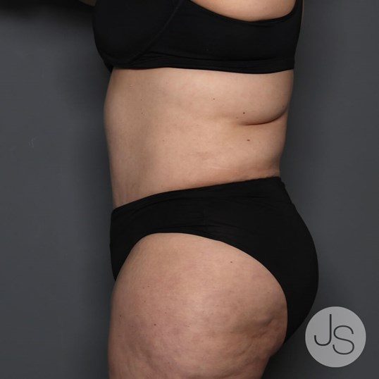 Tummy Tuck Before and After Pictures Beverly Hills, CA