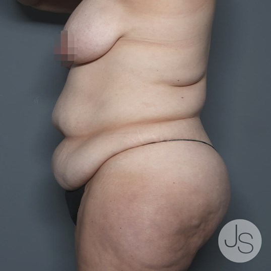 Tummy Tuck Before and After Pictures Beverly Hills, CA