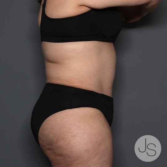 Tummy Tuck Before and After Pictures Beverly Hills, CA