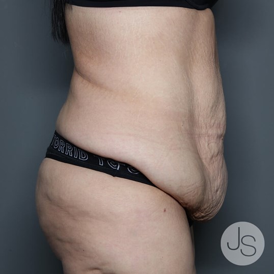 After Weight Loss Surgery Before and After Pictures Beverly Hills, CA