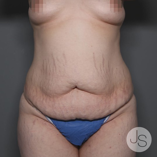 Tummy Tuck Before and After Pictures Beverly Hills, CA