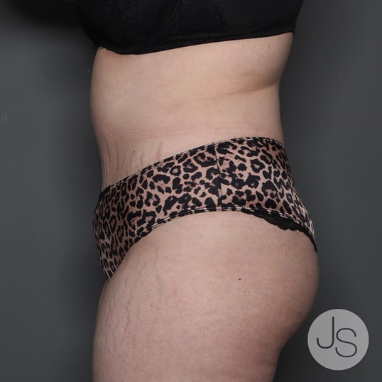 Tummy Tuck Before and After Pictures Beverly Hills, CA