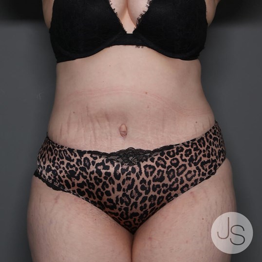 Tummy Tuck Before and After Pictures Beverly Hills, CA