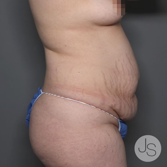 Tummy Tuck Before and After Pictures Beverly Hills, CA