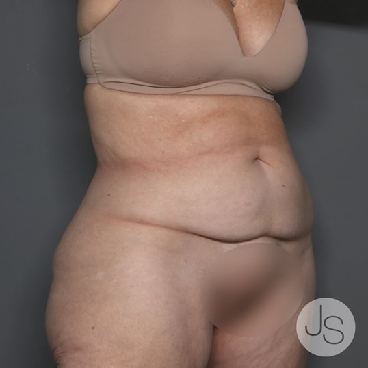 Tummy Tuck Before and After Pictures Beverly Hills, CA