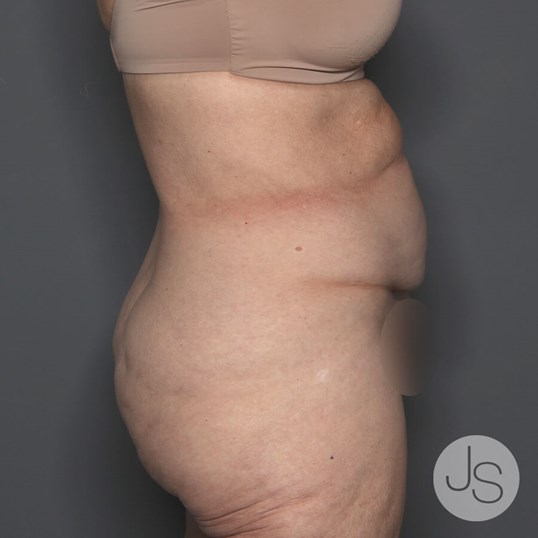 Tummy Tuck Before and After Pictures Beverly Hills, CA