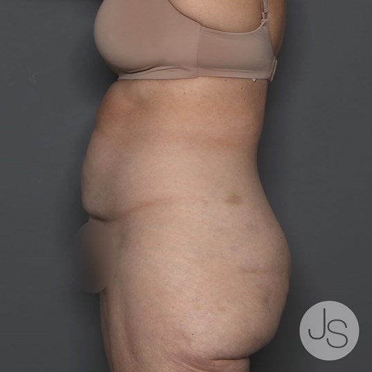 Tummy Tuck Before and After Pictures Beverly Hills, CA