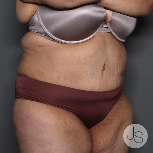 Tummy Tuck Before and After Pictures Beverly Hills, CA