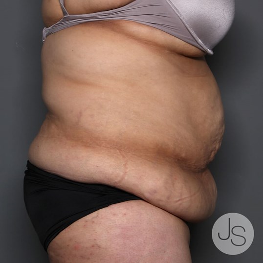 Tummy Tuck Before and After Pictures Beverly Hills, CA