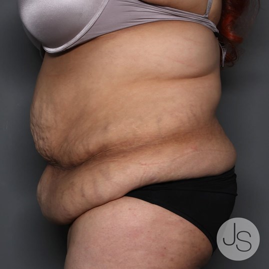 Tummy Tuck Before and After Pictures Beverly Hills, CA