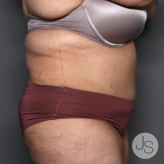 Tummy Tuck Before and After Pictures Beverly Hills, CA