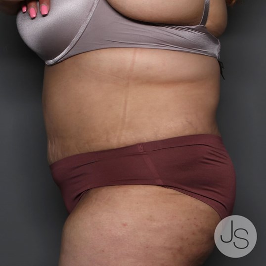 Tummy Tuck Before and After Pictures Beverly Hills, CA