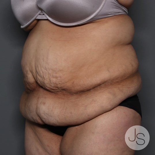 Tummy Tuck Before and After Pictures Beverly Hills, CA