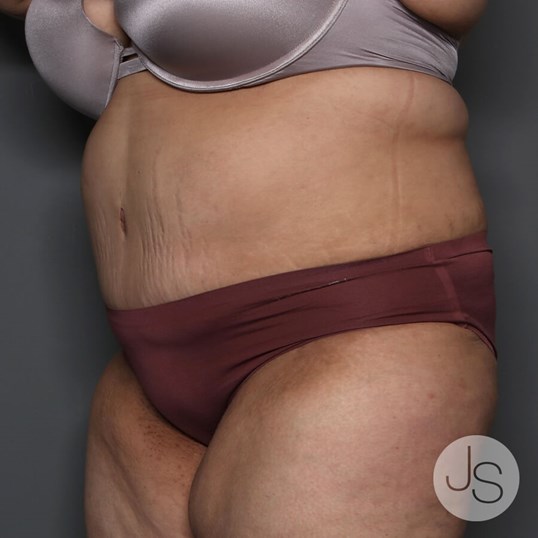 Tummy Tuck Before and After Pictures Beverly Hills, CA