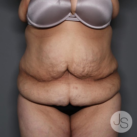 Tummy Tuck Before and After Pictures Beverly Hills, CA