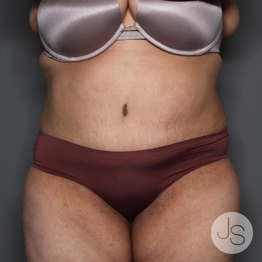 Tummy Tuck Before and After Pictures Beverly Hills, CA