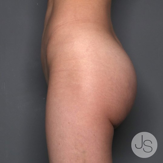 Butt Implants Before and After Pictures Beverly Hills, CA