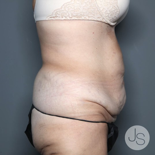 Tummy Tuck Before and After Pictures Beverly Hills, CA