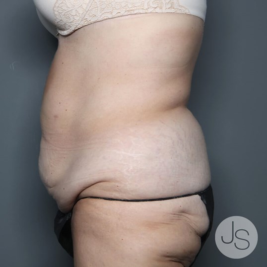 Tummy Tuck Before and After Pictures Beverly Hills, CA