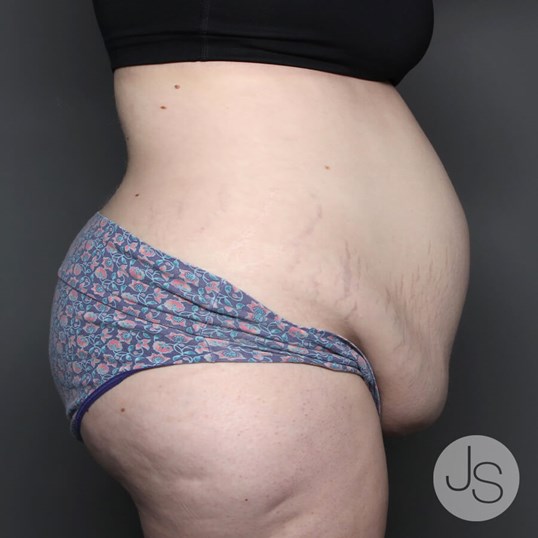 Tummy Tuck Before and After Pictures Beverly Hills, CA