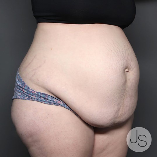 Tummy Tuck Before and After Pictures Beverly Hills, CA