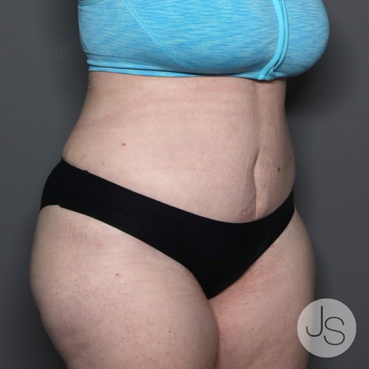 Tummy Tuck Before and After Pictures Beverly Hills, CA